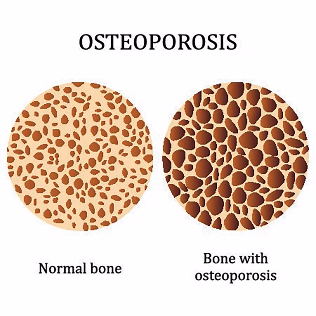 Osteoporosis