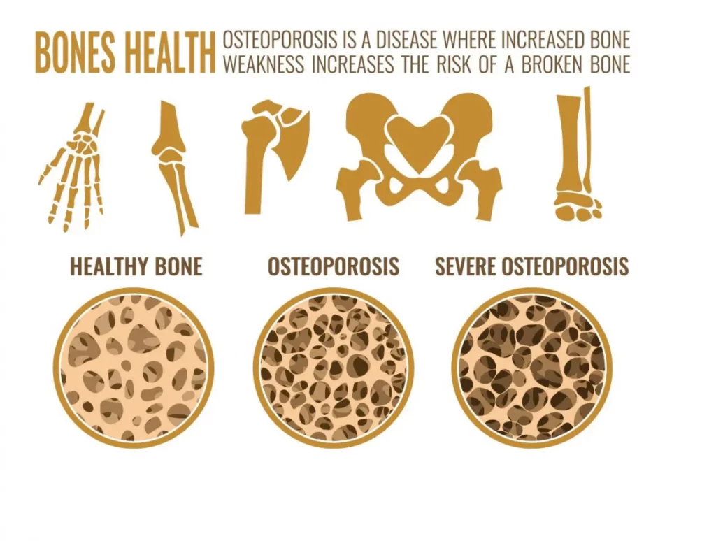 Osteoporosis: Infographic on various stages of osteoporosis